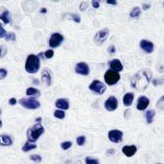 Mês de prevenção ao câncer de colo de Útero – Hibridização colorimétrica para detecção de HPV