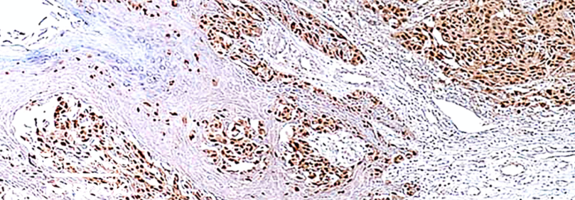 Leia mais sobre o artigo Você já avaliou quão robusto é o seu painel de anticorpos para diagnóstico de melanoma?